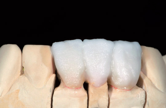 図24　インターナルステインの固定焼成後、TXで歯冠全体をおおうように築盛する。