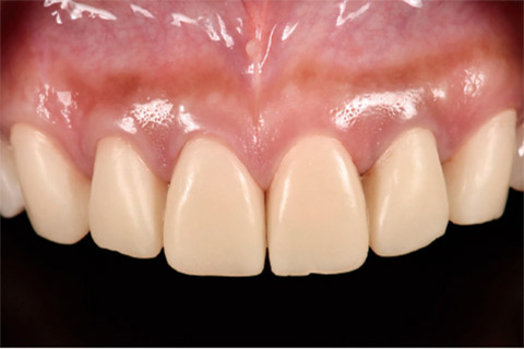 図19 術後3ヵ月の2nd Provisional Restoration。6前歯の歯頸線の左右対称性が維持されている。