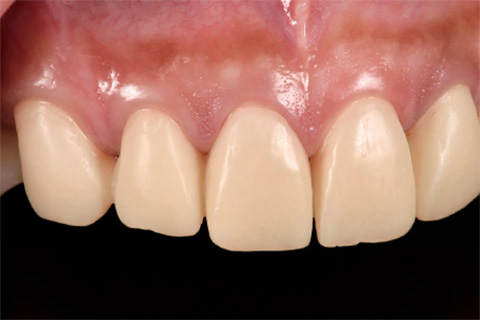 図20 術後3ヵ月の前歯部側方面観。歯周組織は安定している。