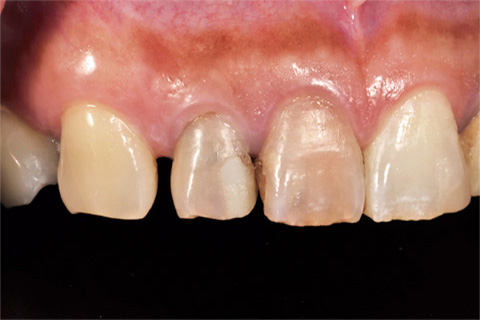 図12 初診時前歯部側方面観。