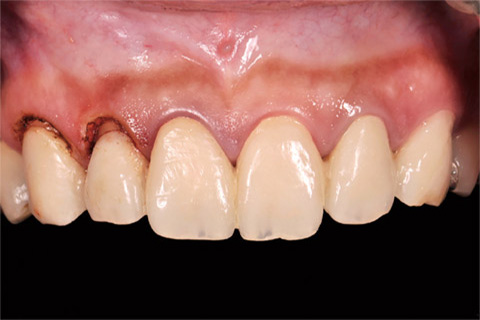図17 6前歯の歯頸線が左右対称となっていることに注目して頂きたい。