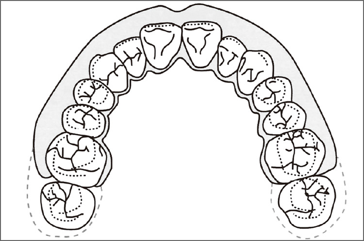 図11 マウスガードの外形線（咬合面観・要説スポーツ歯科医学より引用）。