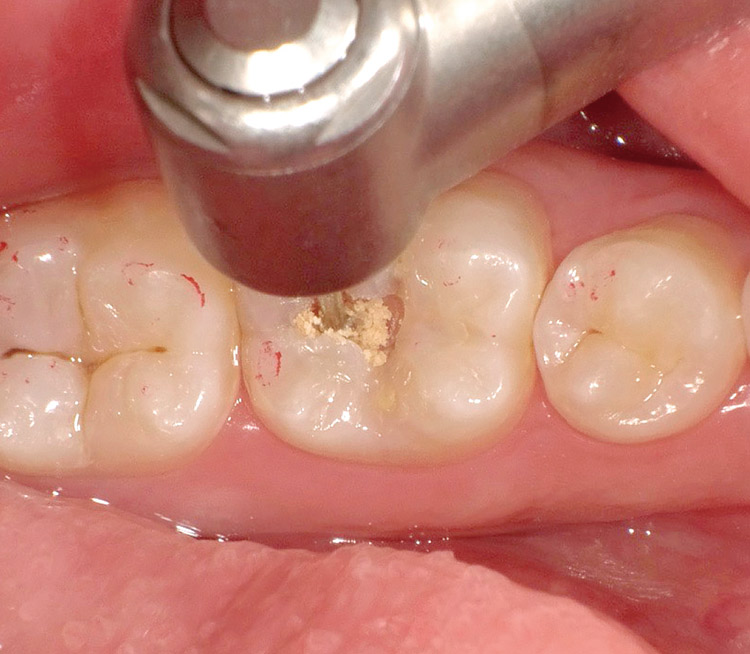 図6 ステンレスラウンドバーを超低速・無注水で使用し感染象牙質を除去。