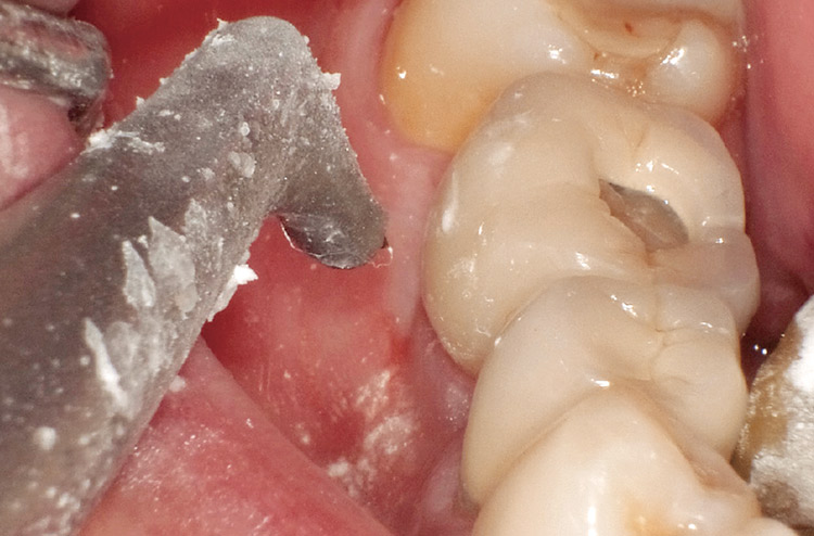 図4 歯肉から5mmはなし、30〜60度角度をつけ歯肉縁下に向かって噴射する。