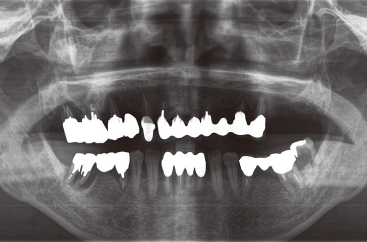 図20 パノラマX線画像。大型の補綴物があり、歯周病の進行も認める。