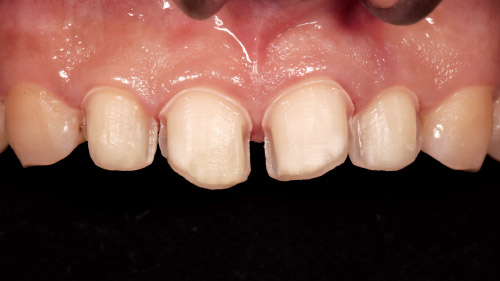 ポーセレンラミネートベニアのCAD/CAMによる4歯同日修復の写真