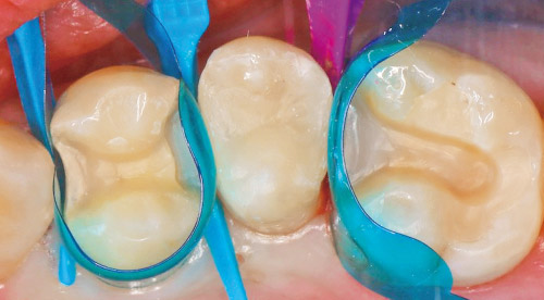 3歯連続インレーの接着の写真