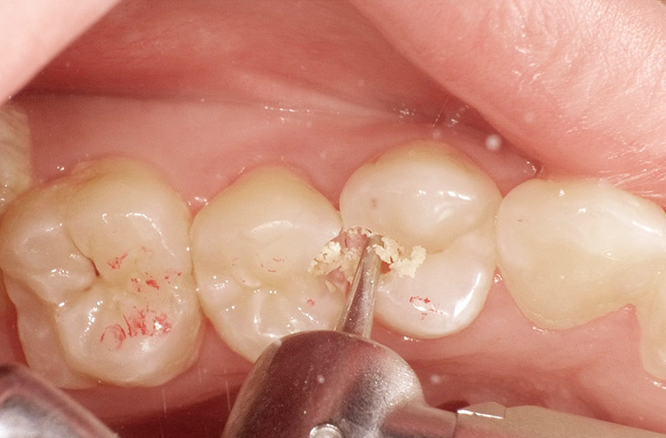 図9　MI ステンレスバー（マニー）にて感染象牙質を選択的に除去。