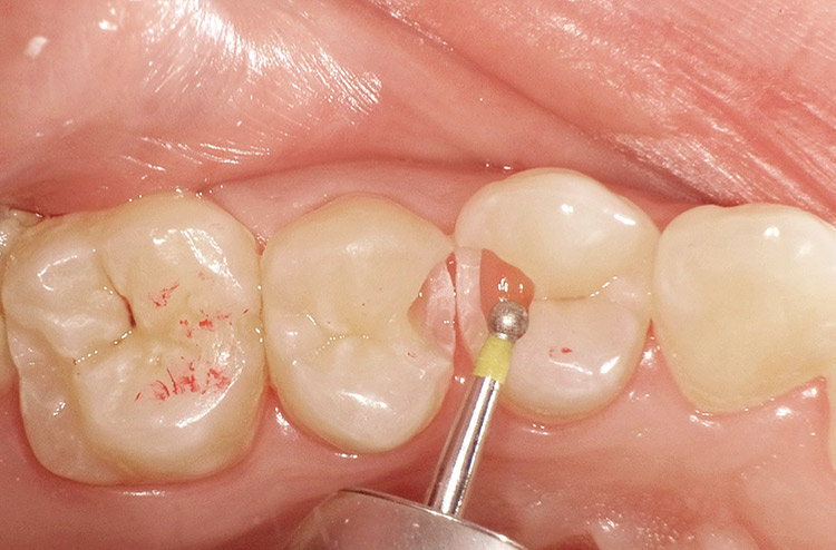 図12　感染象牙質の除去完了後、エクストラファインのダイヤモンドポイントにて窩縁部を整理。