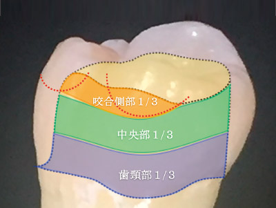 [図] 咬合側部1/3（咬頭の丸みを帯びている部分）・中央部1/3・歯頸部1/3（マージン部分より約3mm）