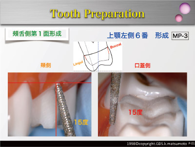 [写真] 頰舌側第1面（歯頸部1/3）形成（使用バー：MP-3）
