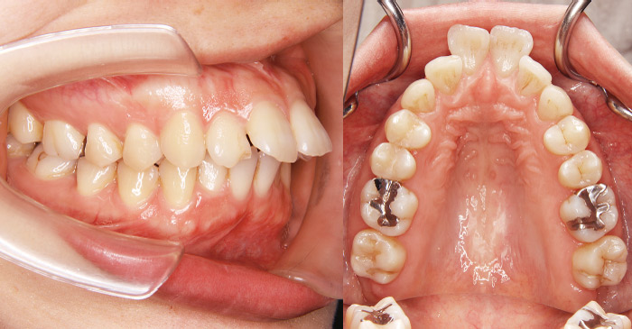 症例1　 上顎両側中切歯の著しい唇側傾斜を伴う上顎前突症例