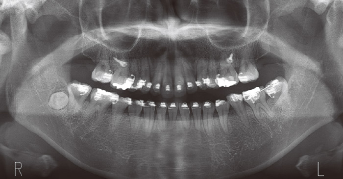 症例1　治療中　パノラマとセファロ画像この画像だけでは切歯管接触のリスクが把握できない。