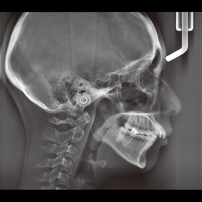症例2　セファロ画像だけでは、上顎前歯部の歯槽突起の前後径、幅を正確に把握できない。