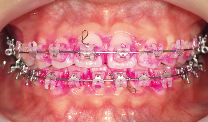 図2　染め出し後の状態。歯間部分やブラケット周辺にたくさんの磨き残しが見られる。