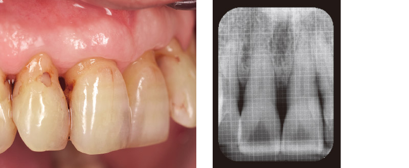 モリタ】歯周外科治療における低侵襲・高効率のアプローチ｜デンタル 