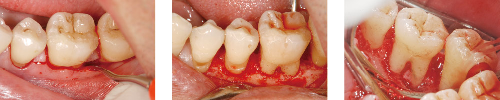 モリタ】歯周外科治療における低侵襲・高効率のアプローチ｜デンタル 