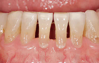 [写真] 歯頸部（歯根露出部）にプラーク付着が見られる