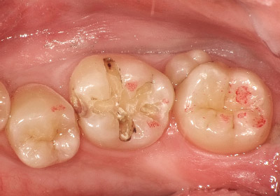 [写真] メタルインレーを除去し、感染象牙質の範囲を確認