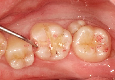 [写真] 感染象牙質を除去