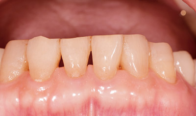[写真] 歯肉の状態は良好であるが、プラークの残存を認め、歯面の光沢も見られない