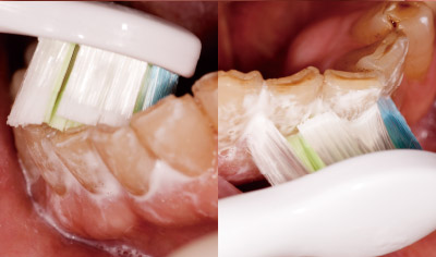 [写真] ソニッケアーに交換して約2週間後の下顎舌側部の状態