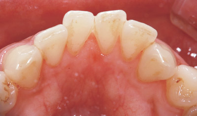 [写真] メインテナンスのたびに前歯舌側面に着色が確認される