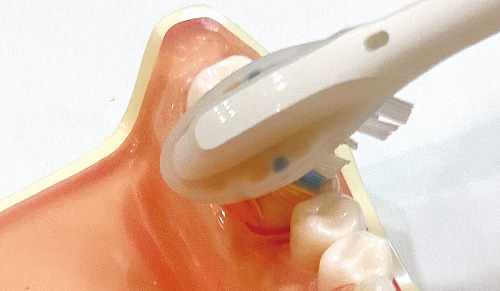 [写真] 小、大臼歯に深いポケットがある場合はブラシを立てて先端のオレンジ色の部分をポケット部分に沿わせて磨く