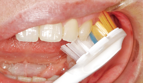 [写真] 歯間部分や歯頸部の深いポケットにアプローチしながら、ブラシの中央部分の毛束が歯面をしっかり磨いてくれる