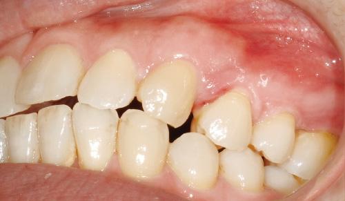 [写真] 上顎の小臼歯