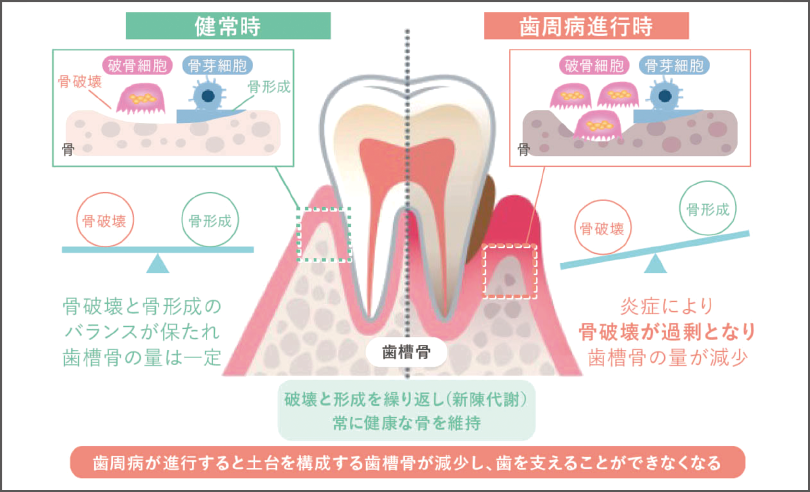 [図] 健常時と歯周病進行時における歯槽骨の代謝