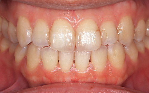[写真] 歯周基本治療終了後の口腔内