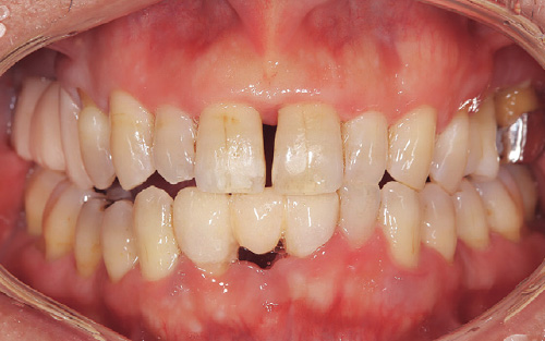 [写真] 歯肉縁上の歯石除去後の口腔内