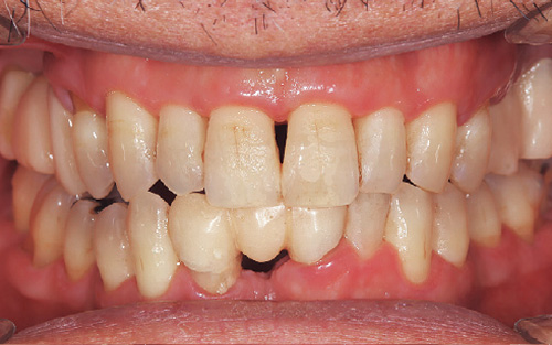 [写真] 歯肉縁下の歯石除去後の口腔内