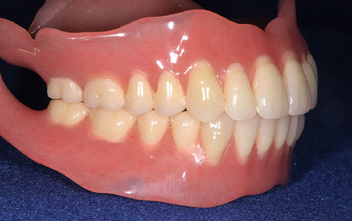 [写真] 新製した総義歯