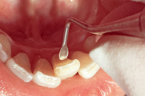 [写真] 歯石を除去
