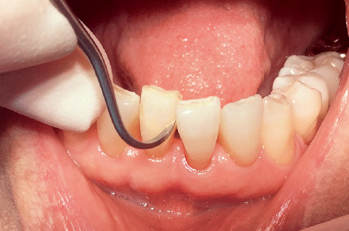 [写真] 細かい部位の歯石除去