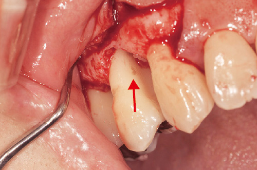 [写真] 歯周組織再生療法における歯肉剥離時の状態