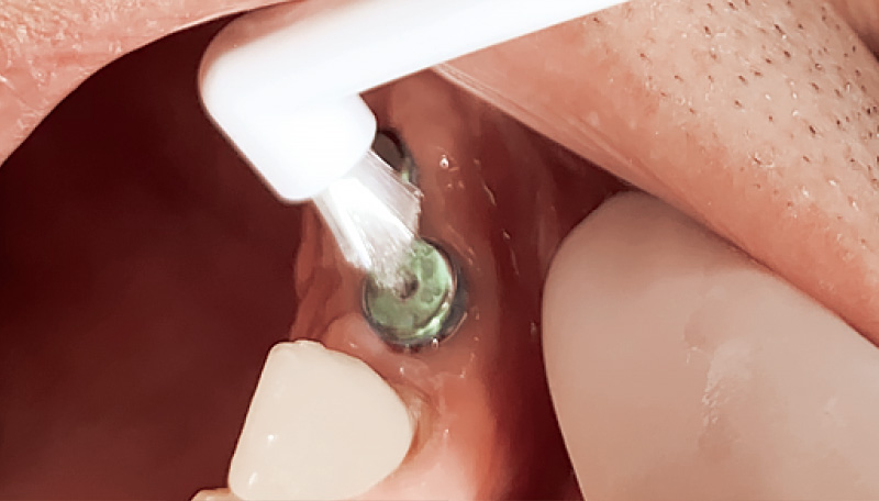 [写真] 通常の歯ブラシでは届きにくい部分にはワンタフトタイプのDENT.EX Implantcare（OT）を使用