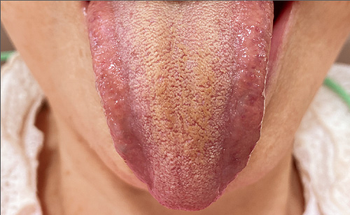 [写真] 舌磨きブラシ使用前