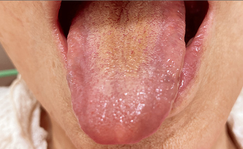 [写真] 舌磨きブラシ使用後