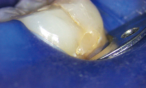 [写真] 6の歯頸部に充填されているCRのマージンが劣化している