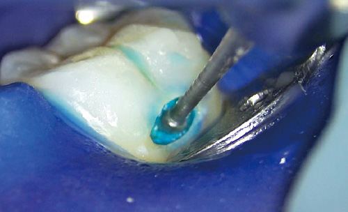 [写真] う蝕検知液を用いながらう蝕象牙質外層の除去