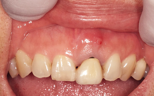 [写真] 上顎左側中切歯において補綴物の浮き、頰側の歯肉腫脹が認められた