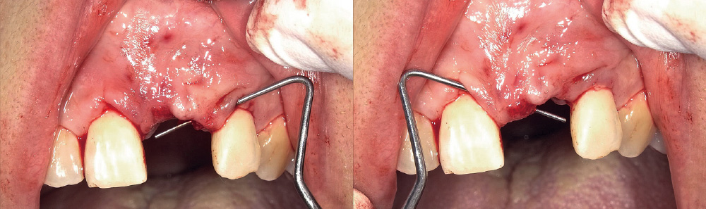 [写真] テンポラリークラウンを一度外し、両隣在歯の歯肉溝からインプラント部位までを、MGJを超えるようにエンベロープ形成した