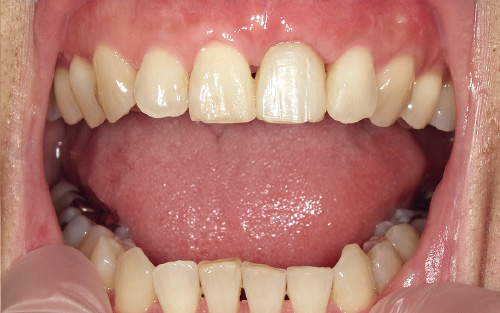 [写真] テンポラリークラウンの歯肉部形態をCRを盛り足して修正し、歯肉の調整を行った