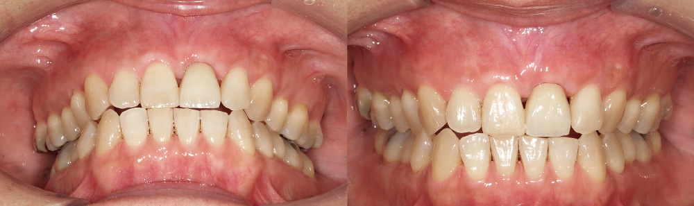 [写真] 歯間乳頭の圧迫を減らし、歯間ブラシの挿入を優先した補綴形態