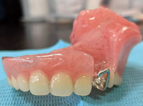 [写真] 顎義歯