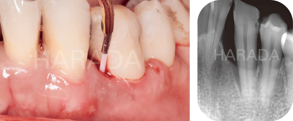 [写真] 歯肉をクローズした状態でEr：YAGレーザーの照射を行い、最後にリグロス®を注入している