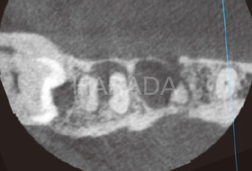 [写真] CT上では分岐部病変が根中央部を超えて欠損しているが頰側の骨がわずかであるが残っているのがわかる